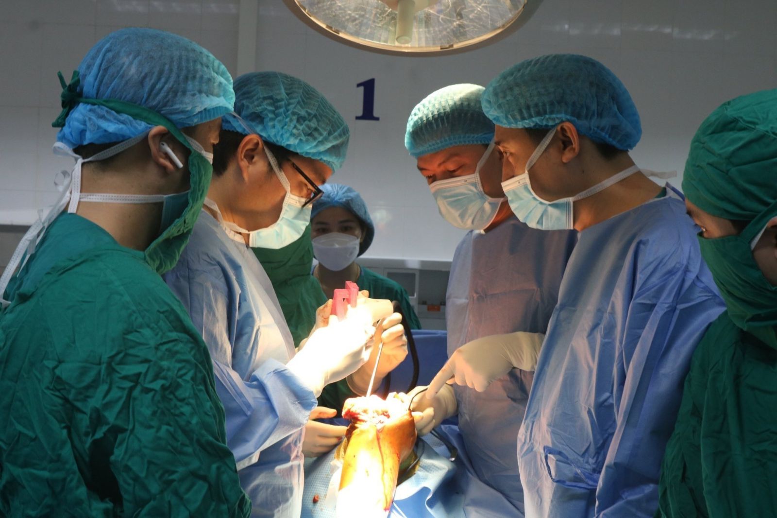 GS.TS. Trần Trung Dũng (người đeo kính) hỗ trợ các bác sĩ BVĐK tỉnh Hà Tĩnh phẫu thuật thay khớp gối toàn phần (công nghệ 3D) cho bệnh nhân. Ảnh: BVĐK tỉnh Hà Tĩnh