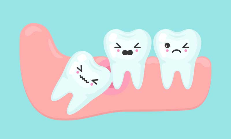 Răng khôn mọc lệch có thể gây tổn thương răng lân cận. Nguồn: hamburgdentalcare.com