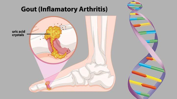 Gene, chứ không phải chế độ ăn uống, có thể là nguyên nhân chính đứng sau các bệnh viêm khớp do gút.