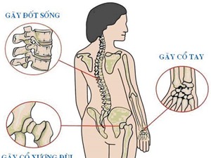 Dấu hiệu bạn bị loãng xương mà không biết