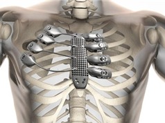 In xương lồng ngực bằng kỹ thuật 3D
