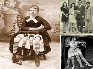 Những dị nhân nhiều chân vượt qua nghịch cảnh