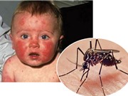 Khuyến cáo đặc biệt trong bối cảnh virus Zika vây kín Việt Nam
