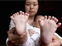 Bé trai người Trung Quốc có 16 ngón chân 