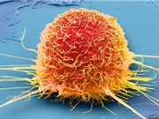 Cách làm đói tế bào ung thư không làm suy kiệt bệnh nhân