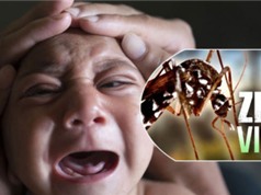 Em bé Việt Nam đầu tiên nghi mắc chứng đầu nhỏ do virus Zika