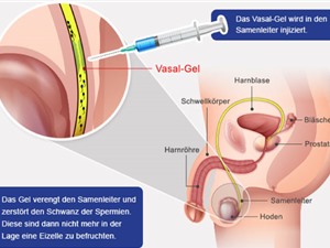 Clip: Phương pháp tránh thai mới cho nam giới, hiệu quả 100%