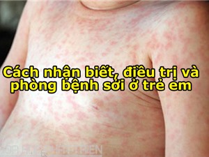 Cách nhận biết, điều trị và phòng bệnh sởi ở trẻ em