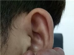 Phẫu thuật thành công ca sẹo lồi “khủng” ở dái tai