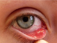 Nguyên nhân, cách phòng ngừa bệnh đau mắt đỏ
