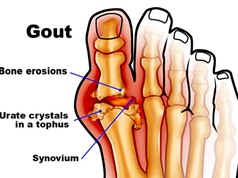 Nguyên nhân, cách phòng tránh bệnh Gout