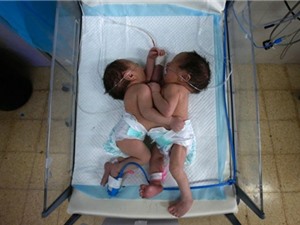 Cặp song sinh người Palestine dính liền chung tim