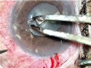 Clip: Tìm được con giun dài 14mm trong mắt người