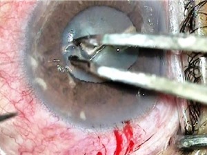 Clip: Tìm được con giun dài 14mm trong mắt người