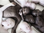 Trẻ bạch tạng bị giết hại làm thần chú và độc dược ở châu Phi