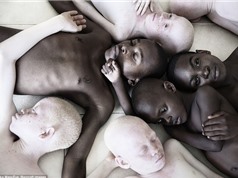 Trẻ bạch tạng bị giết hại làm thần chú và độc dược ở châu Phi