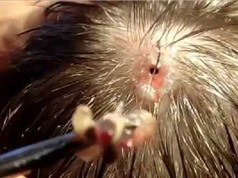 Clip: Rùng rợn gắp được con dòi dài 30 mm trên da đầu