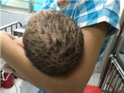 Tắm lá chữa thủy đậu, bé trai 4 tháng tuổi bị nhiễm độc da toàn thân