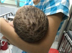 Tắm lá chữa thủy đậu, bé trai 4 tháng tuổi bị nhiễm độc da toàn thân
