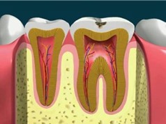 Clip: Quá trình lấy tủy răng diễn ra như thế nào?