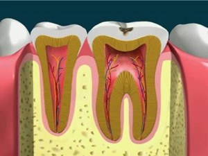 Clip: Quá trình lấy tủy răng diễn ra như thế nào?