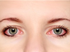Người bệnh đau mắt đỏ kiêng ăn gì?