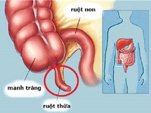 Lời khuyên dành cho bệnh nhân sau khi mổ ruột thừa