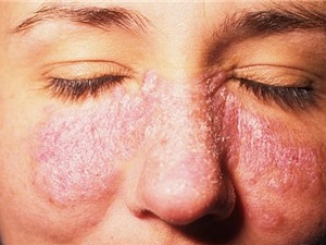 Lupus ban đỏ hệ thống có nguy hiểm không?