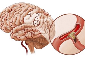 Phát hiện và xử trí khi người thân bị tai biến mạch máu não