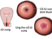 Dấu hiệu sớm của ung thư cổ tử cung