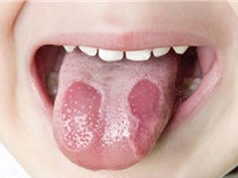 Nhận biết bệnh lưỡi bản đồ ở trẻ em và cách điều trị
