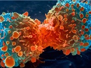 Tế bào ung thư di căn vì “chật chội”