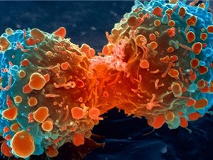 Tế bào ung thư di căn vì “chật chội”
