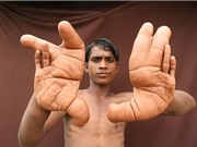 Cậu bé bị dân làng gọi là "quỷ dữ" vì đôi tay to bất thường