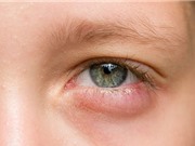 11 lý do khiến mắt sưng húp và cách khắc phục