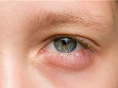 11 lý do khiến mắt sưng húp và cách khắc phục