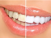 Clip: 10 mẹo hay làm trắng răng bằng nguyên liệu có sẵn trong bếp