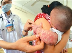 Bệnh sởi gia tăng: Bác sĩ chỉ cách phân biệt sởi và sốt phát ban