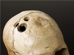 Phẫu thuật khoan sọ đã xuất hiện từ 5.000 năm trước