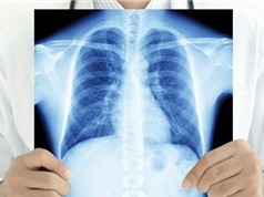 Phát hiện hormone giúp hóa trị điều trị ung thư phổi đạt hiệu quả cao