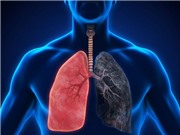 Sử dụng kim loại nặng gallium trong điều trị nhiễm trùng phổi