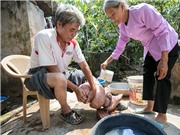 Việt Nam đã loại trừ bệnh phù chân voi