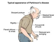 Tiêm tế bào gốc vào não có thể chữa được bệnh Parkinson? 