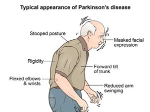 Tiêm tế bào gốc vào não có thể chữa được bệnh Parkinson? 