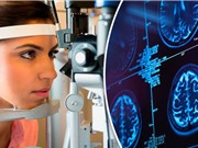 Công nghệ quét mắt giúp chẩn đoán sớm bệnh Parkinson