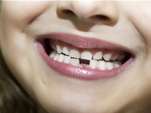 Chẩn đoán các vấn đề sức khỏe tâm thần ở trẻ em qua răng