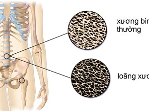 Bổ sung lợi khuẩn giúp giảm loãng xương Bổ sung lợi khuẩn giúp giảm loãng xương