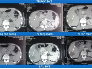 Đốt khối u gan không gây chảy máu