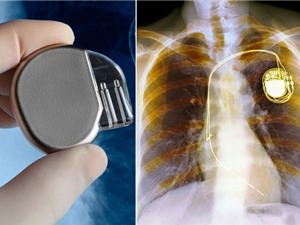 Sắp có máy điều hoà nhịp tim không dùng pin Sắp có máy điều hoà nhịp tim không dùng pin