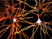 Phát hiện một dạng mất trí nhớ mới dễ nhầm với Alzheimer